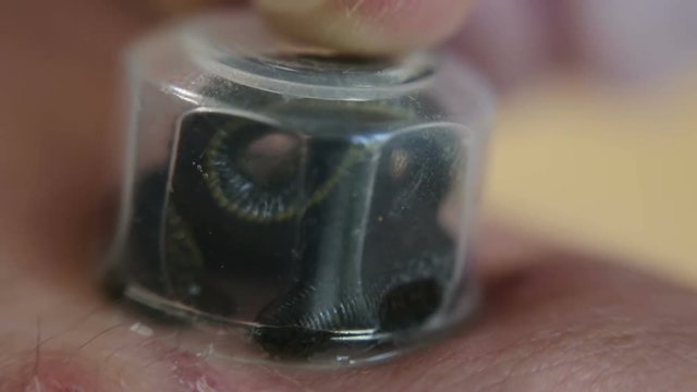 Medical leeches is wiggling in a transparent flask on the patient's skin.