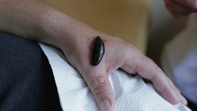 Medical leech is sucking blood from a patient's arm.