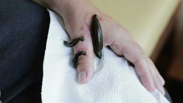 Three medical leeches are sucking blood from a man's hand.
