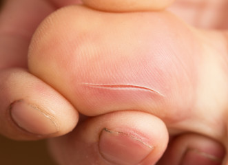a cut on the finger skin