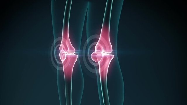 Knee pain animation. Healthy joint and unhealthy painful joint with osteoarthritis.