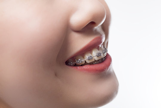 Portrait of a girl with braces
