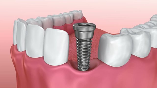 Tooth implant installation process, Medically accurate 3d animation
