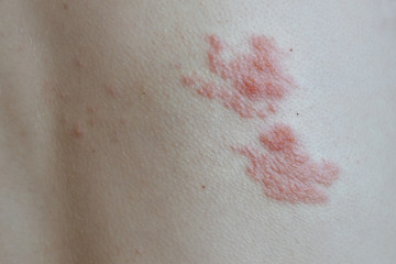 Fototapeta premium Herpes zoster is an acute infectious disease.