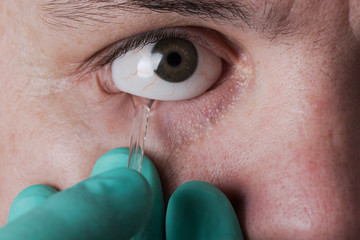 Glass eye prosthetic extraction of Ocular prosthesis
