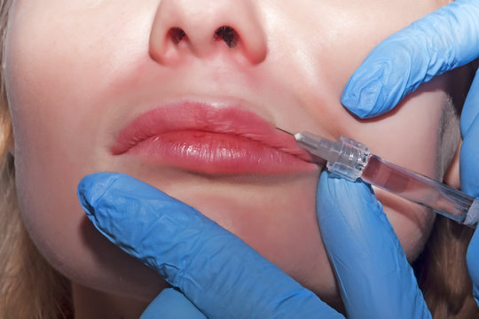 Dermatologist cosmetologist performs contour plastic in the lips with filler to rejuvenate skin
