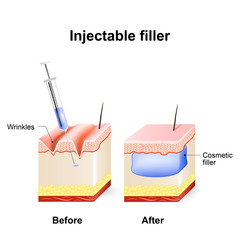 injectable cosmetic filler.  How it works