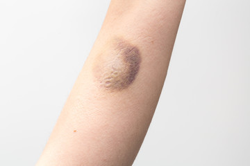 Bruise on female arm