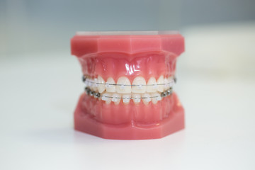 Orthodontic Model, Clear Brace