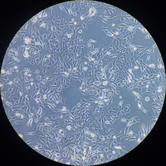 Cancer cells under microscope