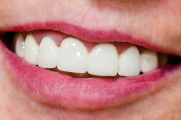 woman with shiny smile and white teeth