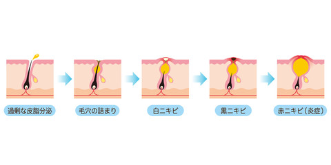 ニキビの進行　毛穴　断面図