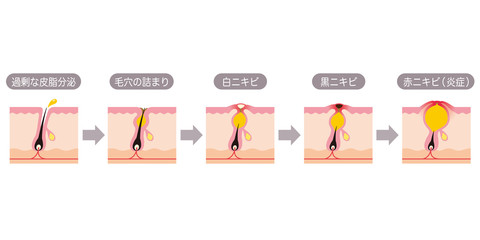 毛穴の構造 角栓 断面図 Wall Mural Wallpaper Murals-koti