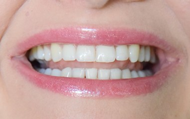Woman white teeth