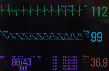 Monitor with a black background. The EKG or electrocardiogram showing normal sinus rhythm  ( green line),  oxygen saturation  ( blue line), blood pressure and temperature on pediatric patient.