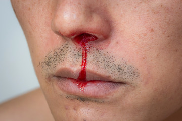 nosebleed , A man is bleeding from his nose.