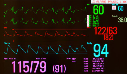 Close up of EKG or electrocardiogram showing paced rhythm with premature beat (green lines), arterial blood pressure (red line), oxygen saturation  (blue line) and noninvasive blood pressure.