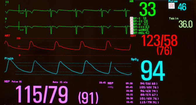Monitor with EKG with significant sinus bradycardia (green line), arterial blood pressure  (red line), oxygen saturation (blue line) and noninvasive blood pressure against a black background 