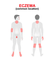 Eczema, dermatitis. Areas of the body most commonly affected.