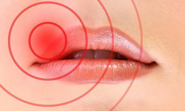 Female lips with herpes virus, closeup
