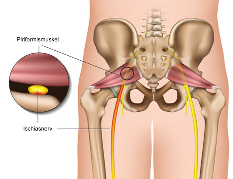 Piriformis syndrom, medical vector illustration