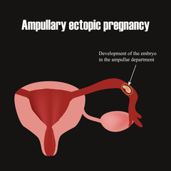 Development of the embryo in the ampullar department. Ectopic pregnancy. Infographics. Vector illustration 