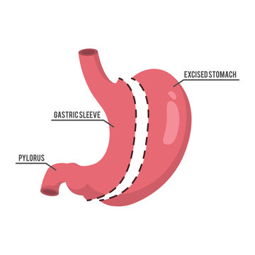 vertical sleeve gastrectomy illustration design
