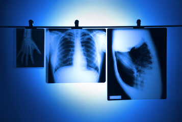lung X-ray and hand hanging negatives