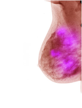 red image breast cancer xray on white background