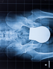 Röntgenaufnahme einer menschlichen Hüfte
