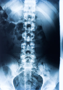 Röntgenbild von Becken und  Wirbelsäule
