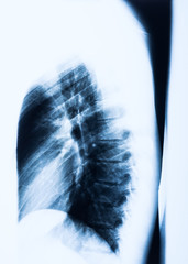 Röntgenbild eines menschlichen BrustkorbesWirbelsäule - obrazy, fototapety, plakaty