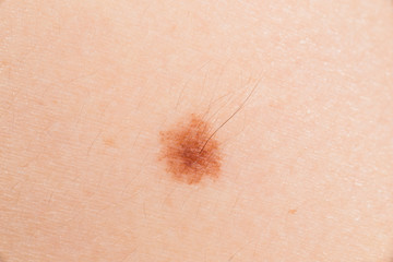 Birthmark on white skin close-up macro