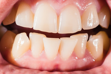 Close-up of a female mouth with crooked teeth and malocclusion
