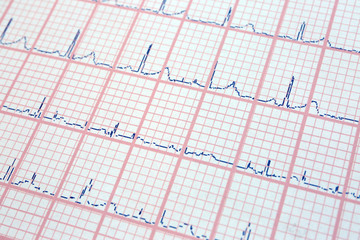 Electrocardiogram in paper form, closeup