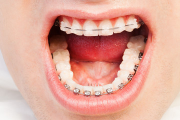 Naklejka premium Wide opened mouth with self-ligating brackets
