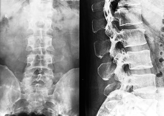 x-ray of the spine lumbar sacral