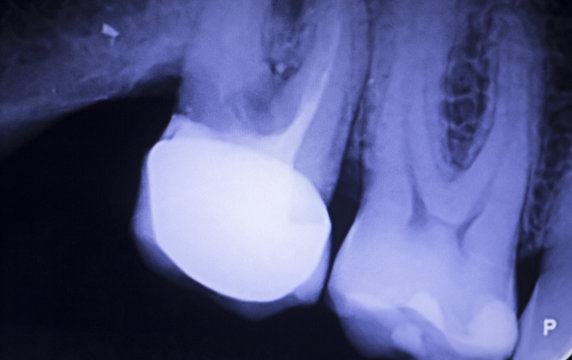Tooth filling dental xray