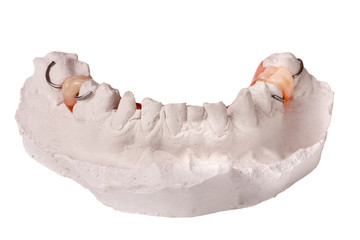plaster cast of teeth with removable partial denture isolated on white background