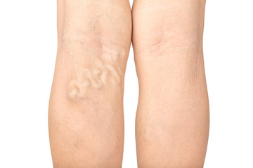 Varicose veins in the legs