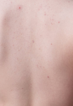 Closeup isolated acne on a woman back