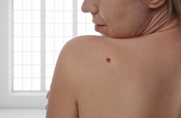 Checking benign moles : Woman with birthmark on her skin