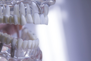 Denture for students transparent