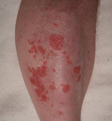 Psoriasis am rechten Fuß