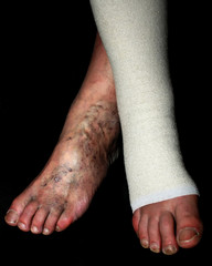 Leg. Varicose, veins. Phlebeurysm. Thrombophlebitis. Elastic bandage.