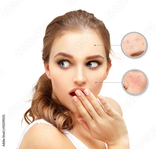 "Post-Acne Marks /Treating Acne Scars " Stock photo and royalty-free