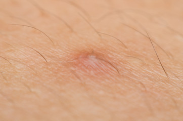 Fototapeta premium macro to close up acne on women skin