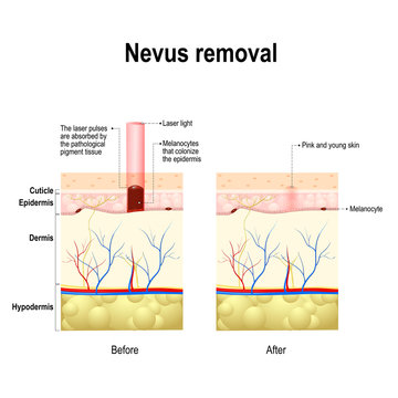 Moles spots or nevus removal