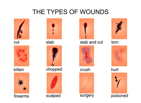 the types of wounds