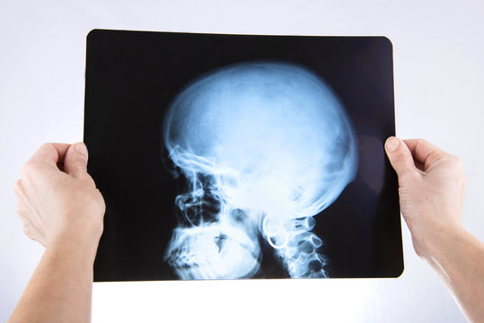 X rays of head